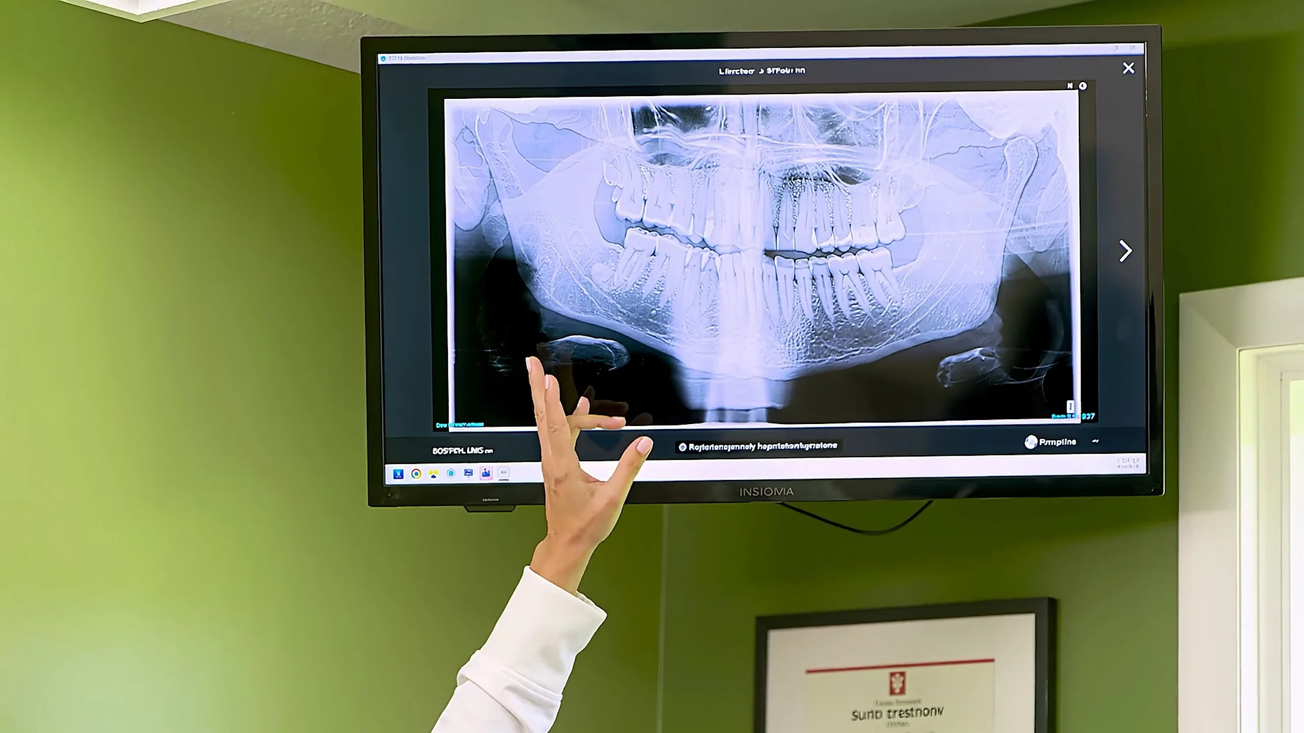 A dentist pointing to a dental X-ray on a screen at Broadway Dentistry in Fort Wayne